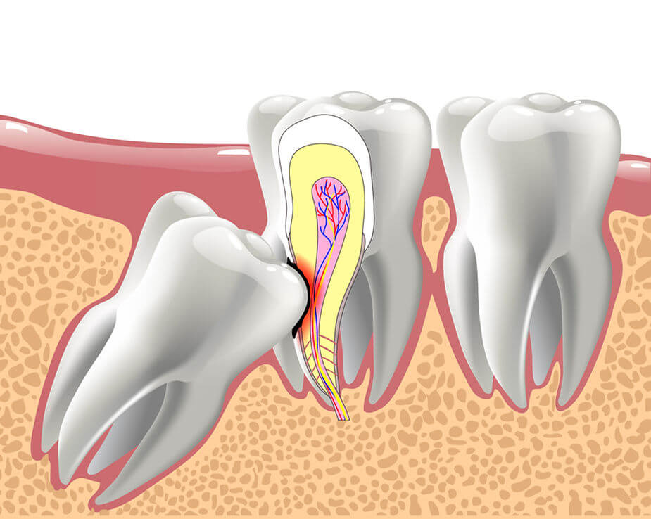 impactedteeth