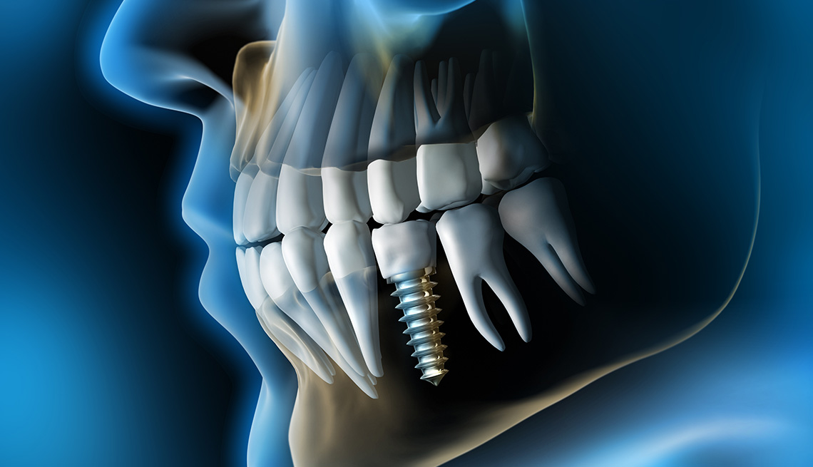 implant