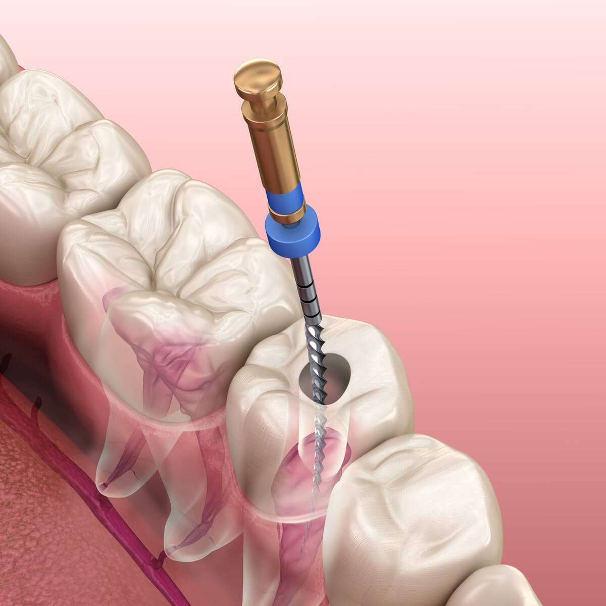 rootcanal